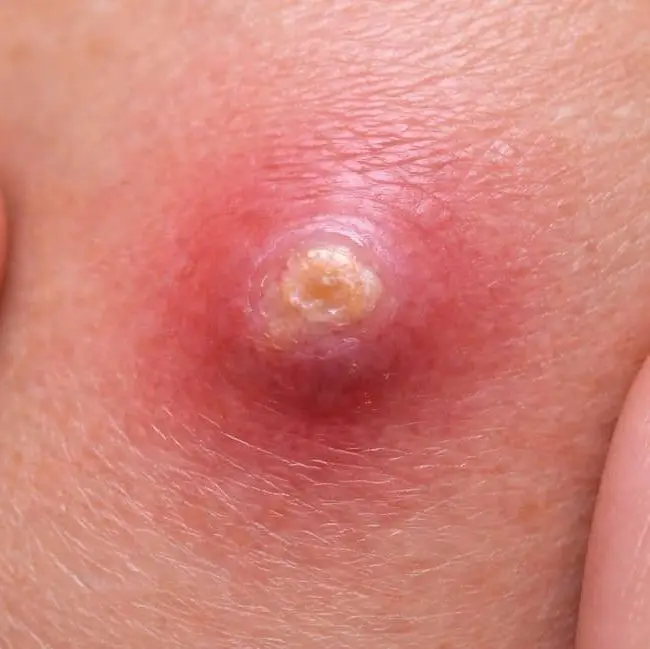 furunkul foto 2