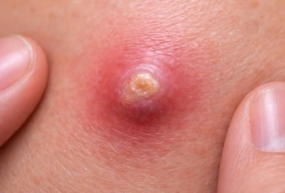 фурункул фото